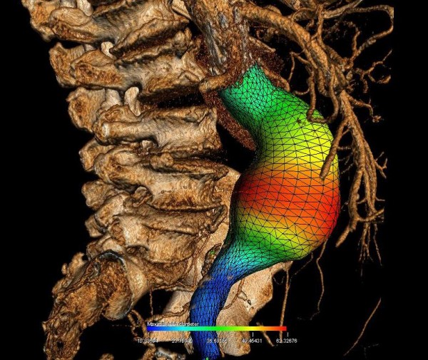 Esta imagen presenta una reconstrucción tridimensional de un aneurisma de aorta abdominal con una representación del color de su diámetro.