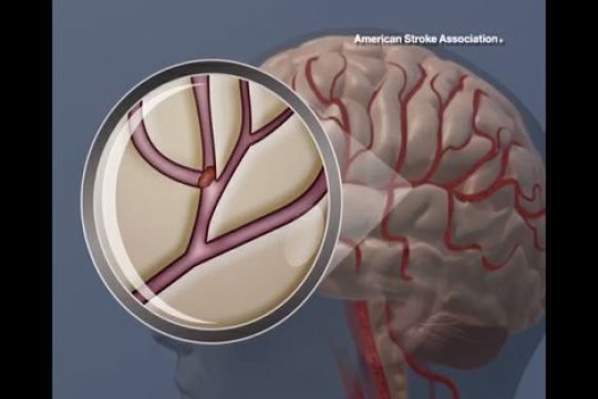 Un coágulo de sangre en el cerebro. Fuente: American Heart Association