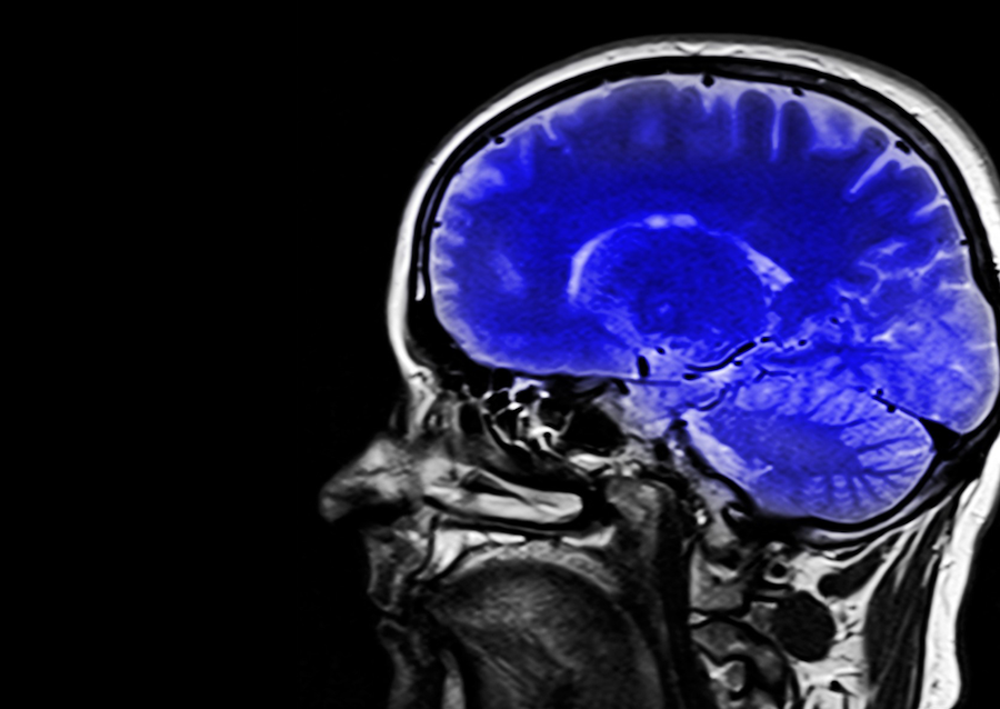 función cognitiva parkinson enfermedad de alzheimer obesidad tratamiento demencia alzheimer cerebro